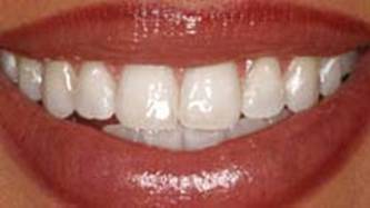 Naples Dentures Dentist